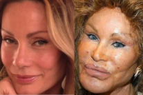 celebrity plastic surgery fails